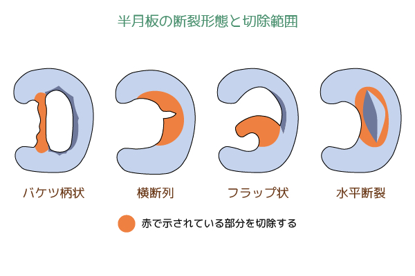 膝の痛みの原因と治療方法について 岐阜市の整形外科 森整形外科