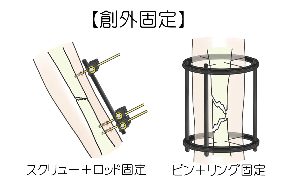 骨折の手術治療について - 岐阜市 - 森整形外科リハビリクリニック