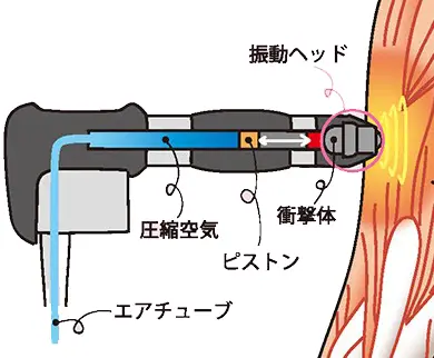 体外衝撃波治療について - 岐阜市 - 森整形外科リハビリクリニック