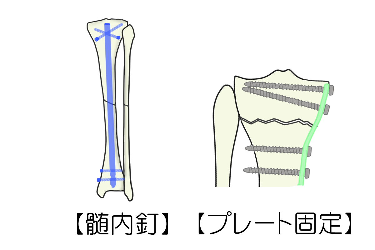 骨折の手術治療について - 岐阜市 - 森整形外科リハビリクリニック
