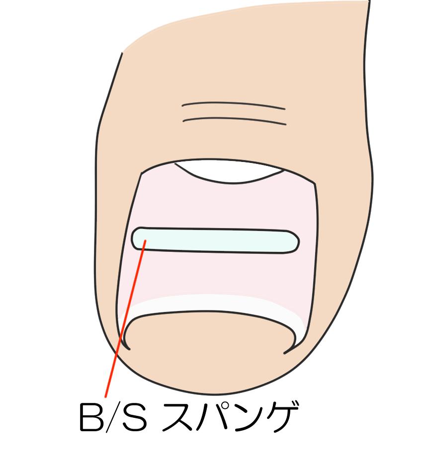 巻き爪に対するB/Sスパンゲ法について - 岐阜市 - 森整形外科 